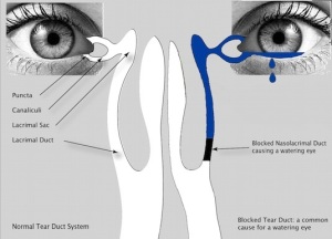 Illustration of Normal Vs. Blocked tear duct